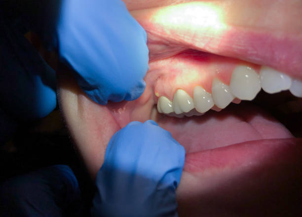 Best Emergency Wisdom Teeth Removal in Villas, NJ